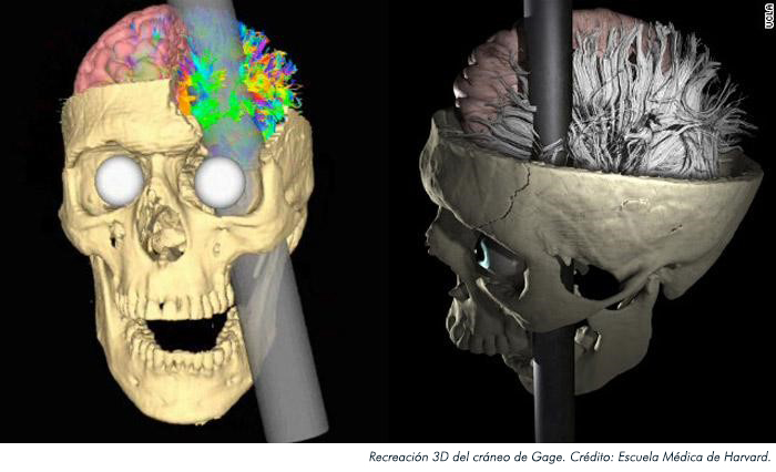 Phineas Gage 2